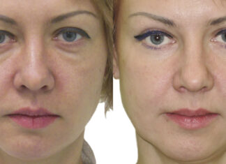 Операция блефаропластика Операция блефаропластика