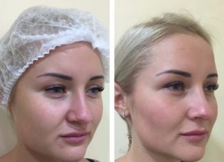 Удаление комков Биша: что это, суть операции, методы проведения и преимущества Удаление комков Биша: что это, суть операции, методы проведения и преимущества