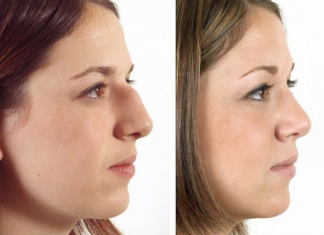 Чи варто робити пластичну операцію: де зробити пластику у Львові, показання, види та протипоказання Чи варто робити пластичну операцію: де зробити пластику у Львові, показання, види та протипоказання