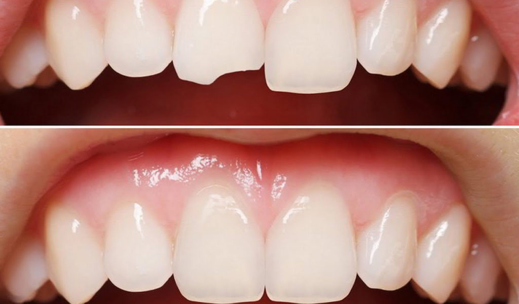 Реставрация зубов в Запорожье: перечень услуг, что это такое, типы реставрации зубов, особенности и преимущества