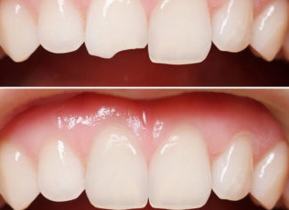 Реставрация зубов в Запорожье: перечень услуг, что это такое, типы реставрации зубов, особенности и преимущества Реставрация зубов в Запорожье: перечень услуг, что это такое, типы реставрации зубов, особенности и преимущества