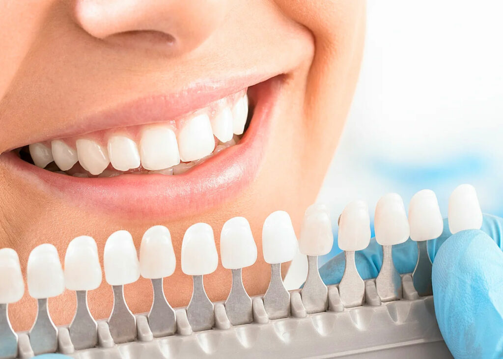 Отбеливание зубов: особенности процедуры и для чего нужно?