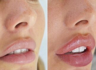 Что следует знать про увеличение губ Что следует знать про увеличение губ