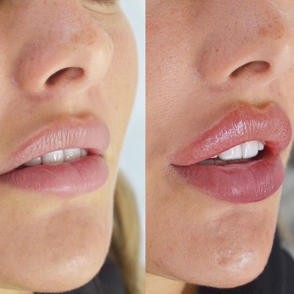 Что следует знать про увеличение губ