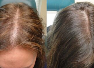 Как предотвратить выпадение волос после родов? Как предотвратить выпадение волос после родов?