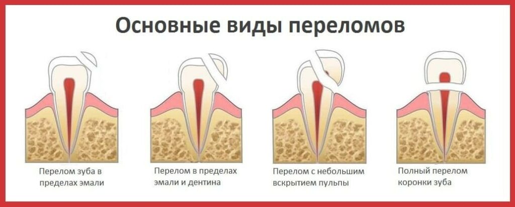 Откололся зуб! Что делать? Отвечает стоматолог Капил Кхурана