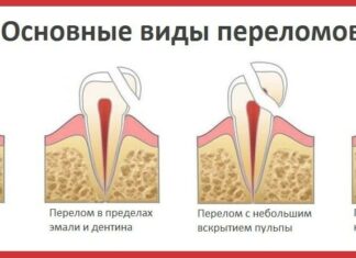 Откололся зуб! Что делать? Отвечает стоматолог Капил Кхурана Откололся зуб! Что делать? Отвечает стоматолог Капил Кхурана