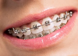 Виды и особенности брекетов Виды и особенности брекетов