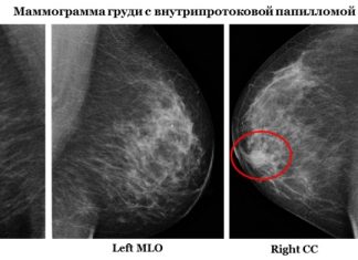 Симптомы болезни Минца Симптомы болезни Минца