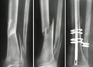 Короткие пептиды при восстановлении повреждений костей