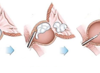 Лікування аденоми простати — чому треба обрати одну з найкращих клінік Львова «Urologist Valetskyi»
