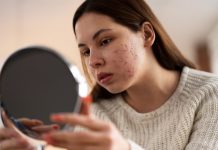 Крем для лица от акне: положительные эффекты и правила выбора