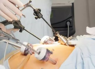 Как проводится лапароскопическая тубэктомия